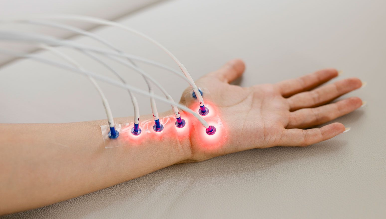 Laserneedle-Therapie, Laser sind an eine Hand angeschlossen, sie leuchten