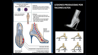 Diagramma del piede e radiografia del tallone con lesioni causate dai tacchi alti