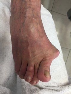Primo piano di un piede gonfio con un alluce valgo sporgente su un asciugamano bianco