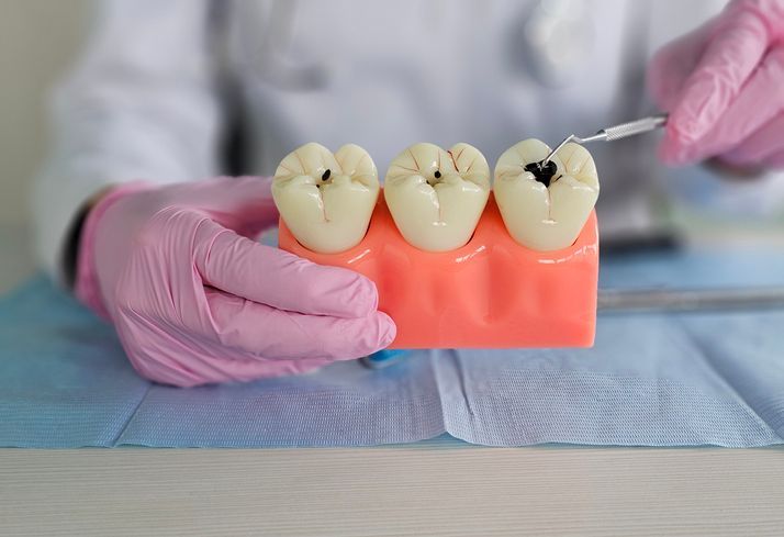 Dentist's hands in pink gloves holding teeth model with cavities; tool points at one.