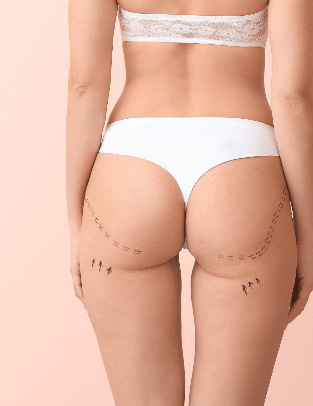 Fat transfer to the butt and hips - 365mc Seoul Liposuction Hospital