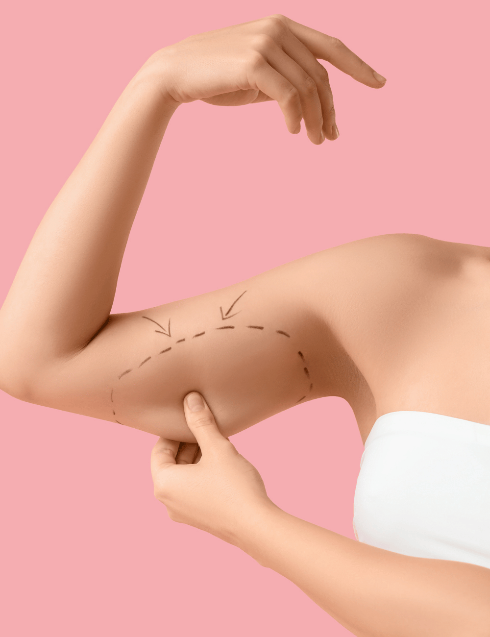 Arms before & after. - 365mc Seoul Liposuction Hospital