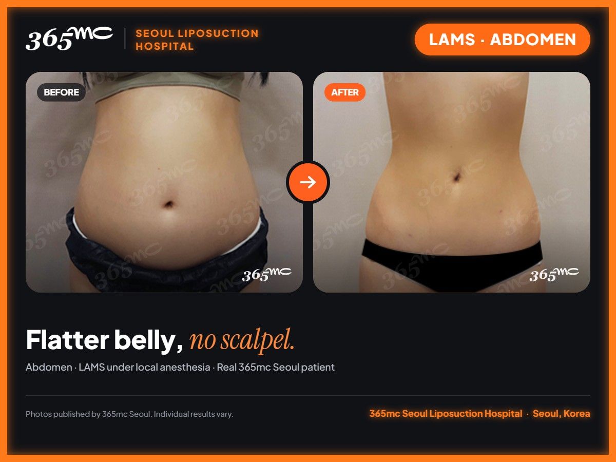 Abdomen LAMS before and after at 365mc Seoul Liposuction Hospital - Flatter belly, no scalpel.