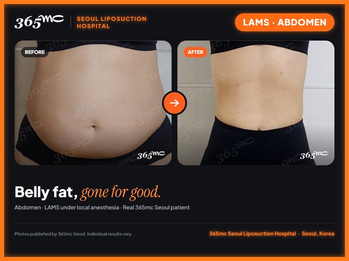 Abdomen LAMS before and after at 365mc Seoul Liposuction Hospital - Belly fat, gone for good.