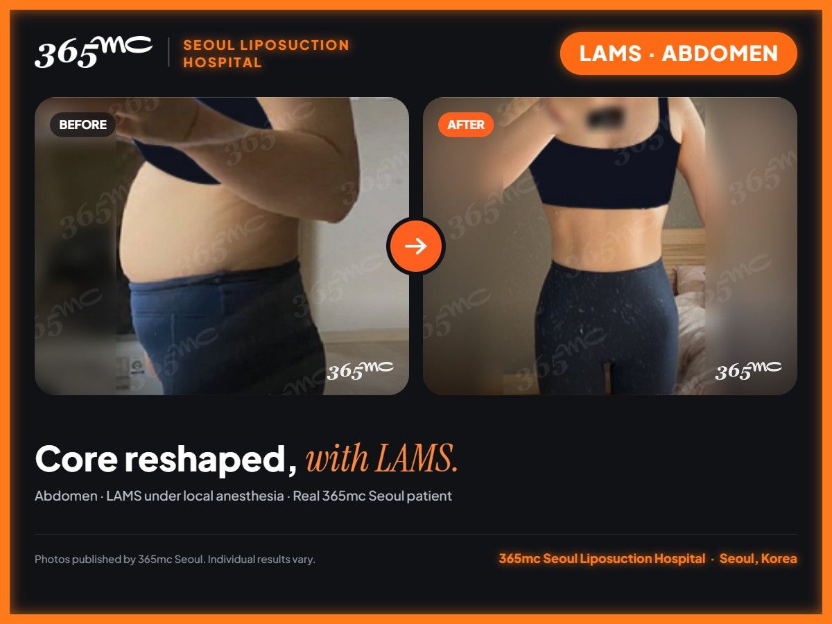 Abdomen LAMS before and after at 365mc Seoul Liposuction Hospital - Core reshaped, with LAMS.