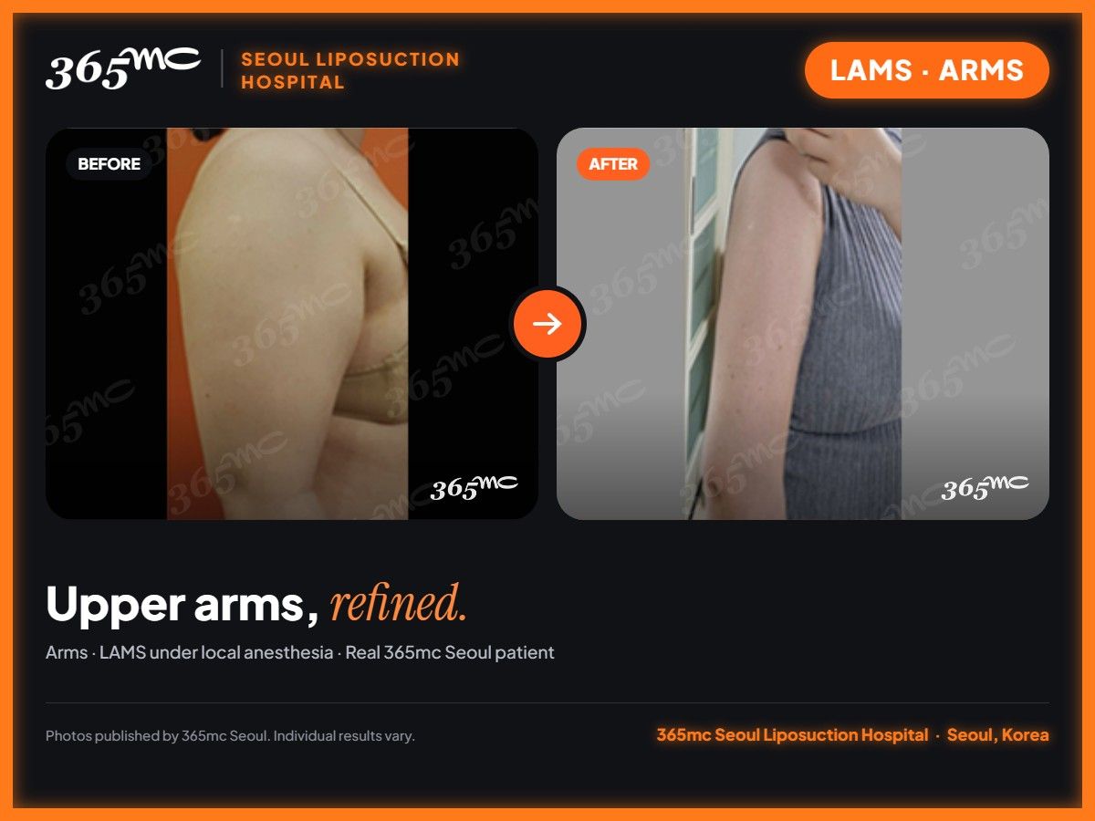 Upper arms LAMS before and after at 365mc Seoul Liposuction Hospital - Upper arms, refined.