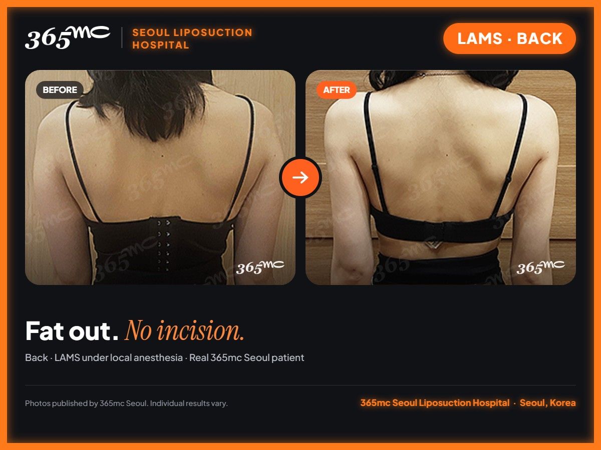 Back LAMS before and after at 365mc Seoul Liposuction Hospital - Fat out. No incision.
