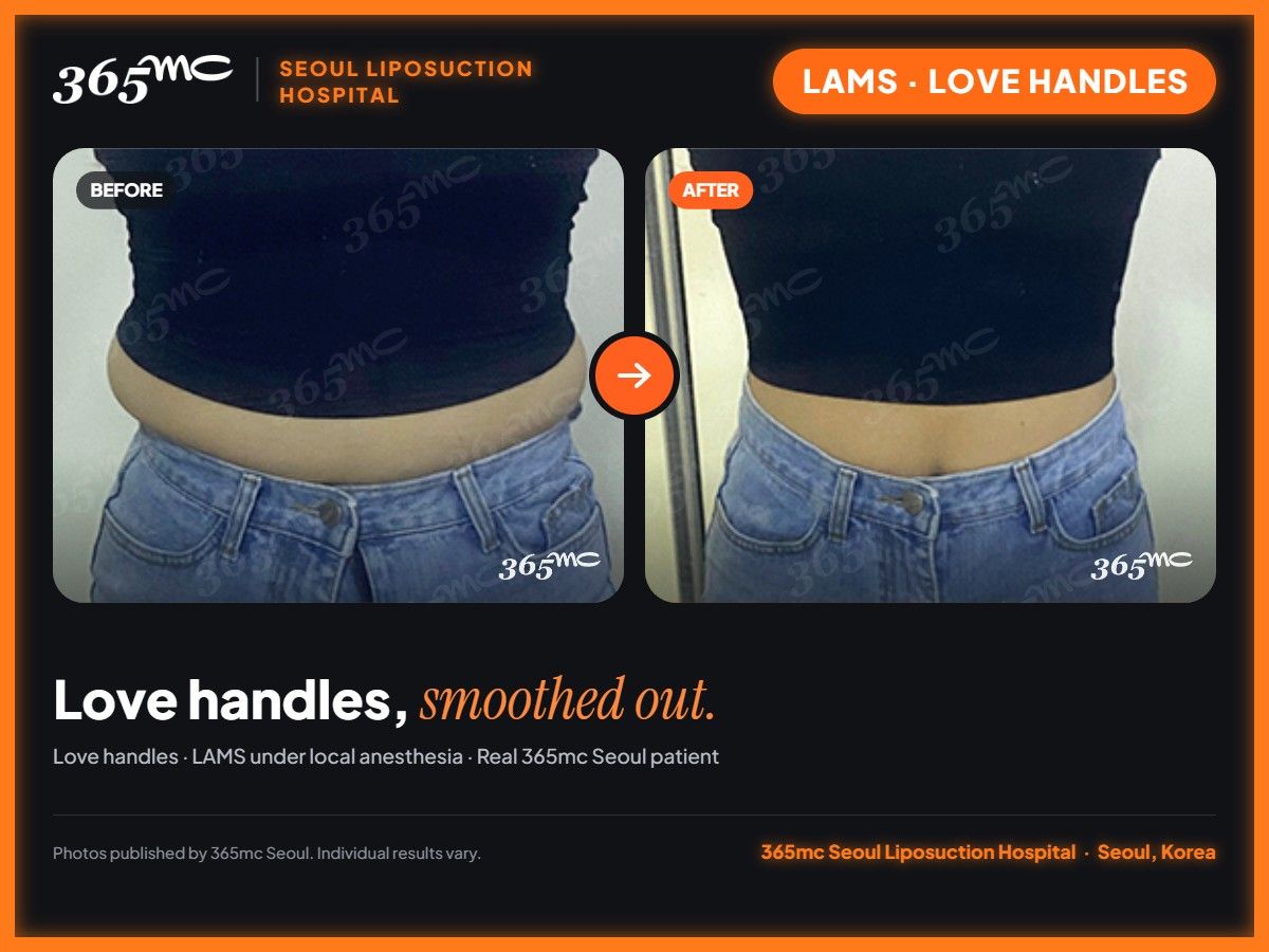 Love handles LAMS before and after at 365mc Seoul Liposuction Hospital - Love handles, smoothed out.