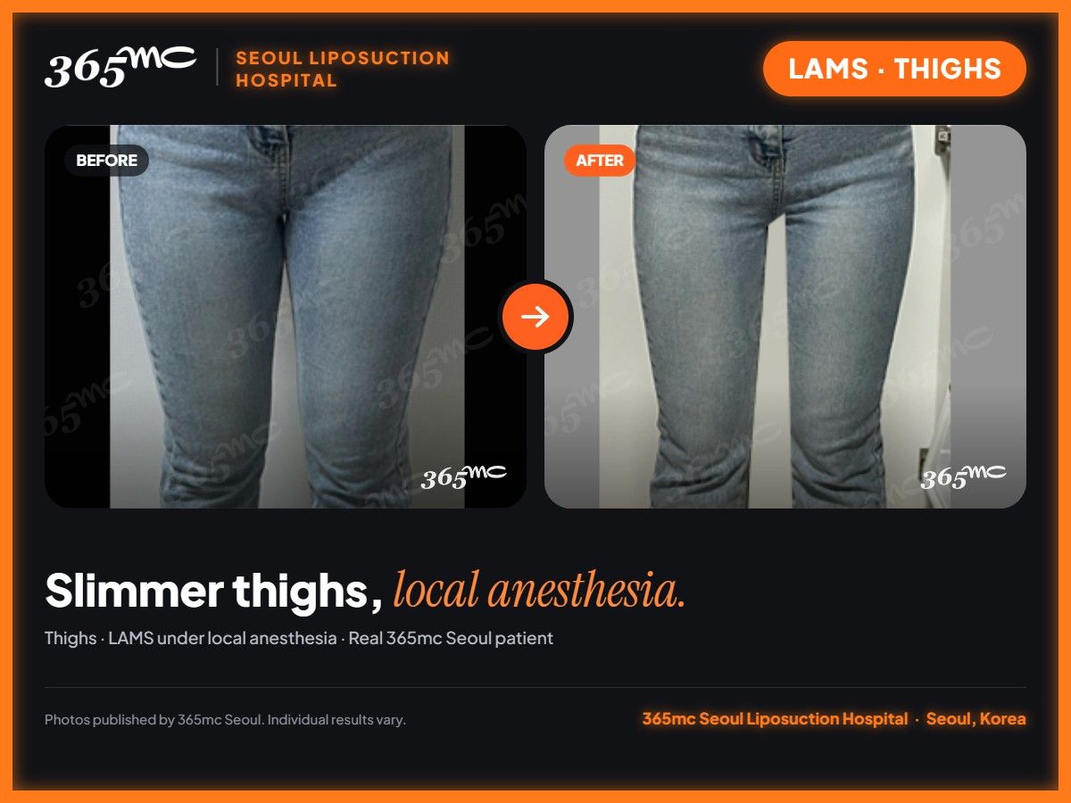 Thighs LAMS before and after at 365mc Seoul Liposuction Hospital - Slimmer thighs, local anesthesia.