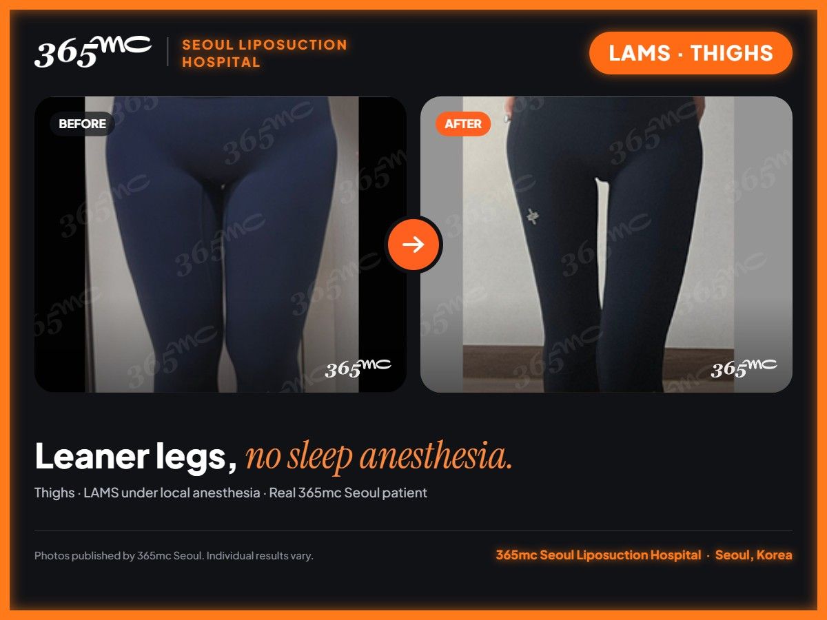 Thighs LAMS before and after at 365mc Seoul Liposuction Hospital - Leaner legs, no sleep anesthesia.