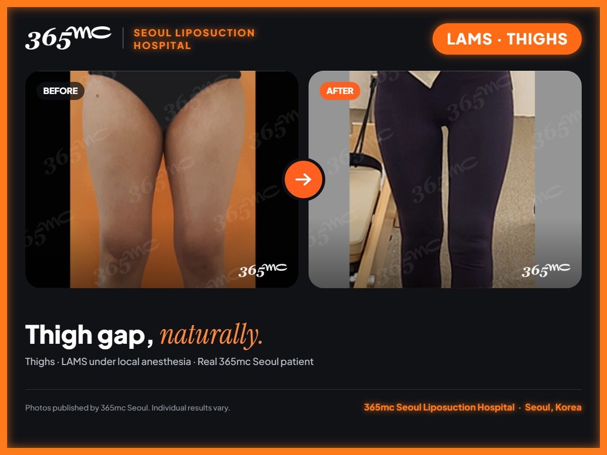 Thighs LAMS before and after at 365mc Seoul Liposuction Hospital - Thigh gap, naturally.