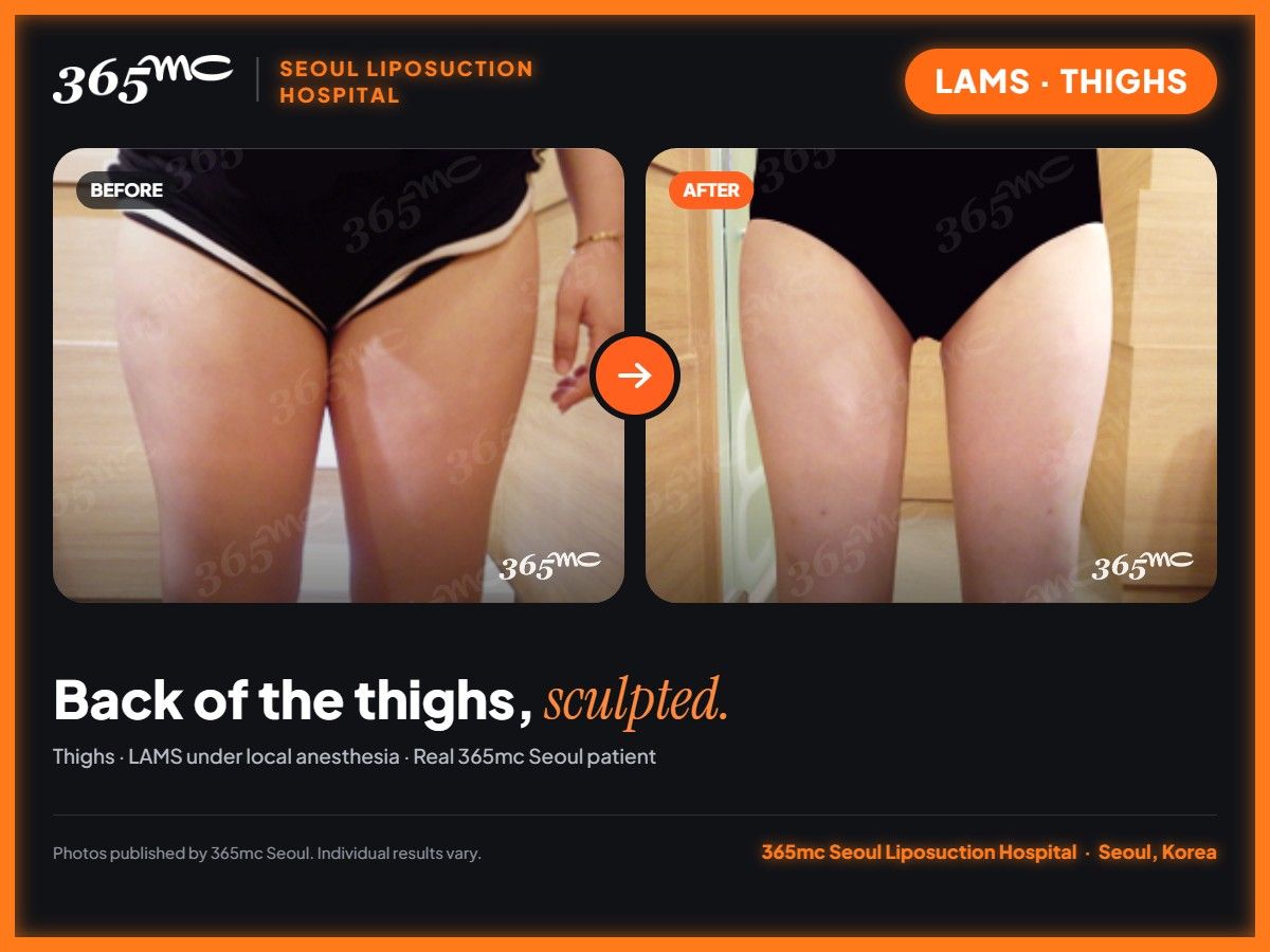 Back of thighs LAMS before and after at 365mc Seoul Liposuction Hospital - Back of the thighs, sculpted.