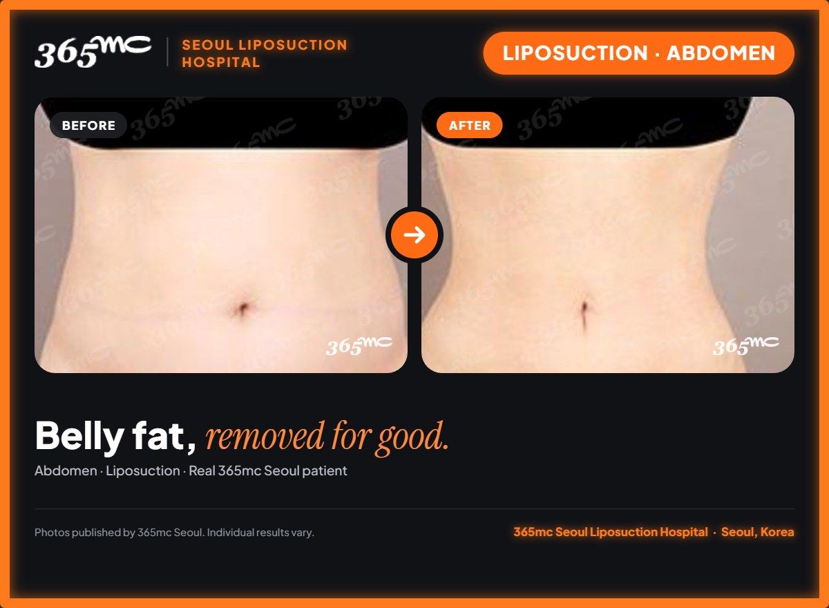 Abdomen liposuction before and after at 365mc Seoul Liposuction Hospital - Belly fat, removed for good.