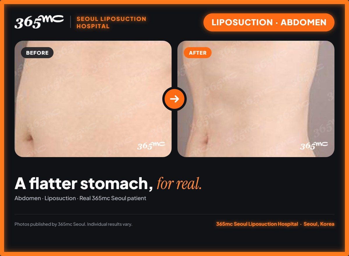 Abdomen liposuction before and after at 365mc Seoul Liposuction Hospital - A flatter stomach, for real.