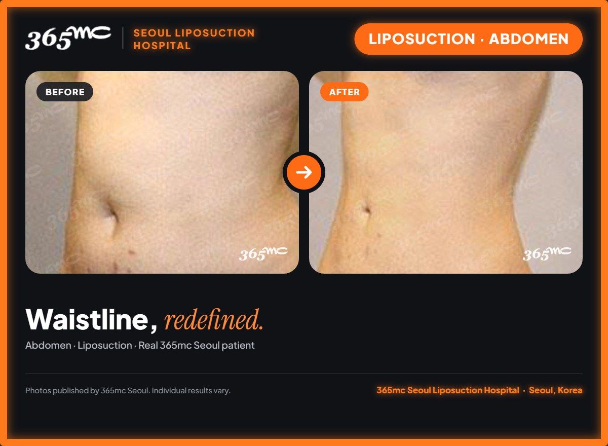 Abdomen liposuction before and after at 365mc Seoul Liposuction Hospital - Waistline, redefined.