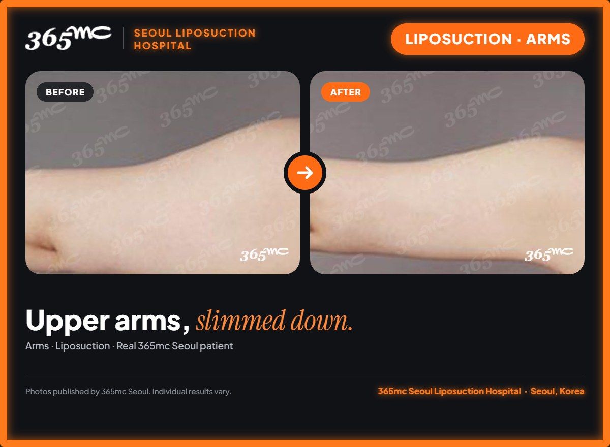 Arms liposuction before and after at 365mc Seoul Liposuction Hospital - Upper arms, slimmed down.