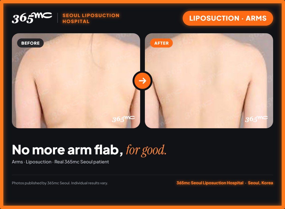 Arms liposuction before and after at 365mc Seoul Liposuction Hospital - No more arm flab, for good.