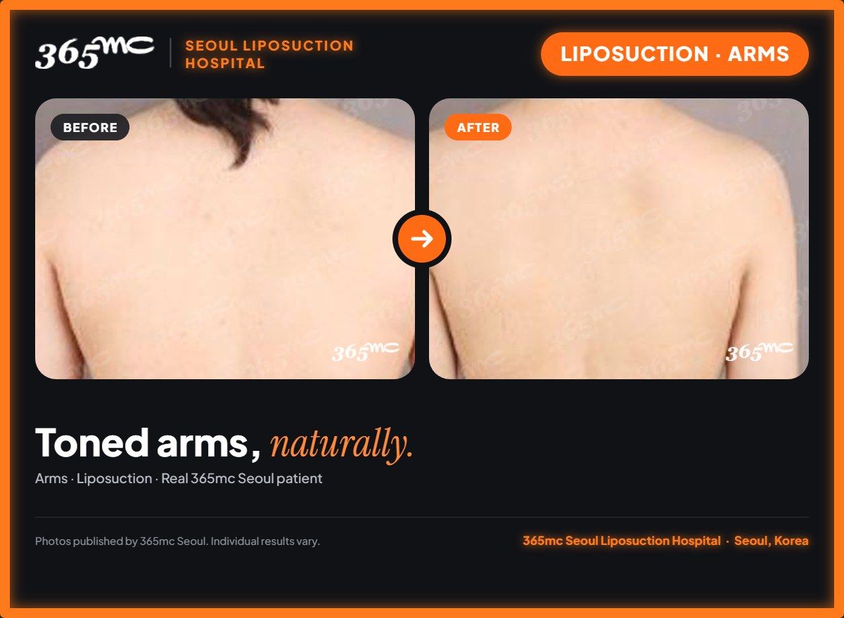 Arms liposuction before and after at 365mc Seoul Liposuction Hospital - Toned arms, naturally.