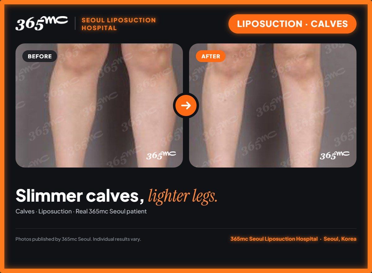 Calves liposuction before and after at 365mc Seoul Liposuction Hospital - Slimmer calves, lighter legs.