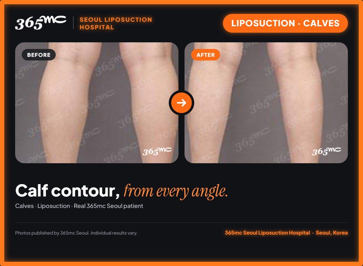 Calves liposuction before and after at 365mc Seoul Liposuction Hospital - Calf contour, from every angle.