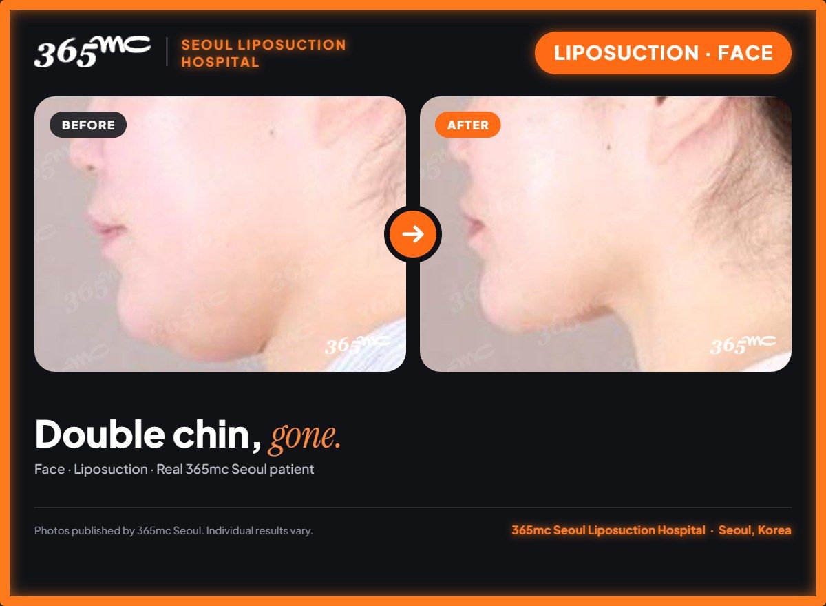 Face liposuction before and after at 365mc Seoul Liposuction Hospital - Double chin, gone.