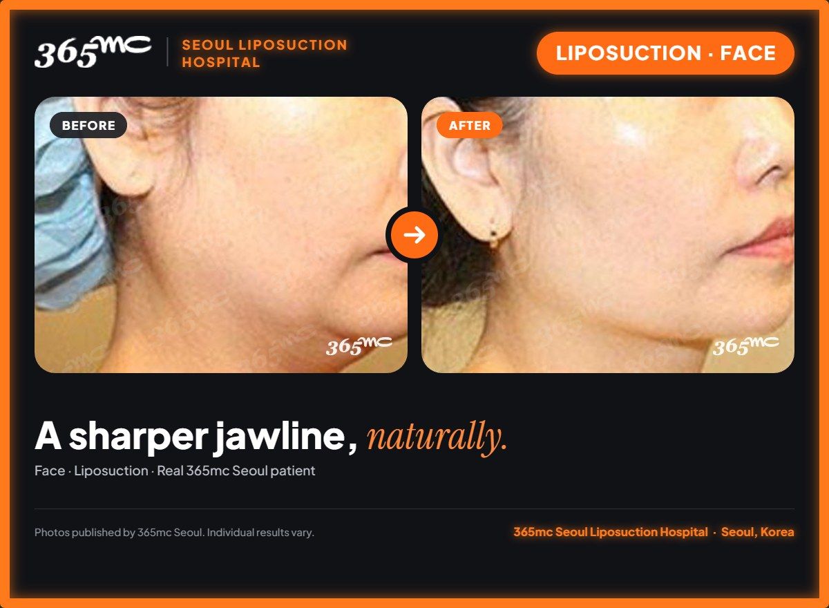 Face liposuction before and after at 365mc Seoul Liposuction Hospital - A sharper jawline, naturally.