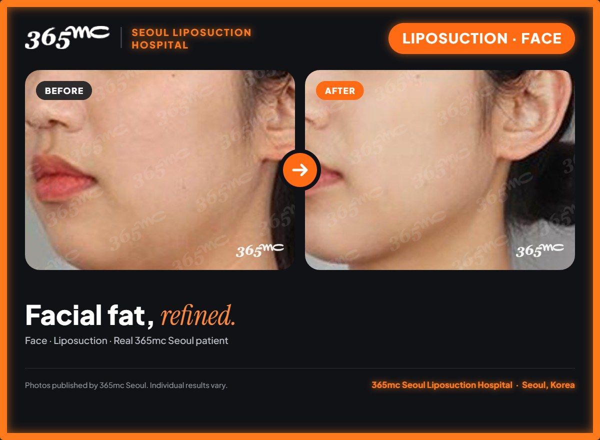Face liposuction before and after at 365mc Seoul Liposuction Hospital - Facial fat, refined.