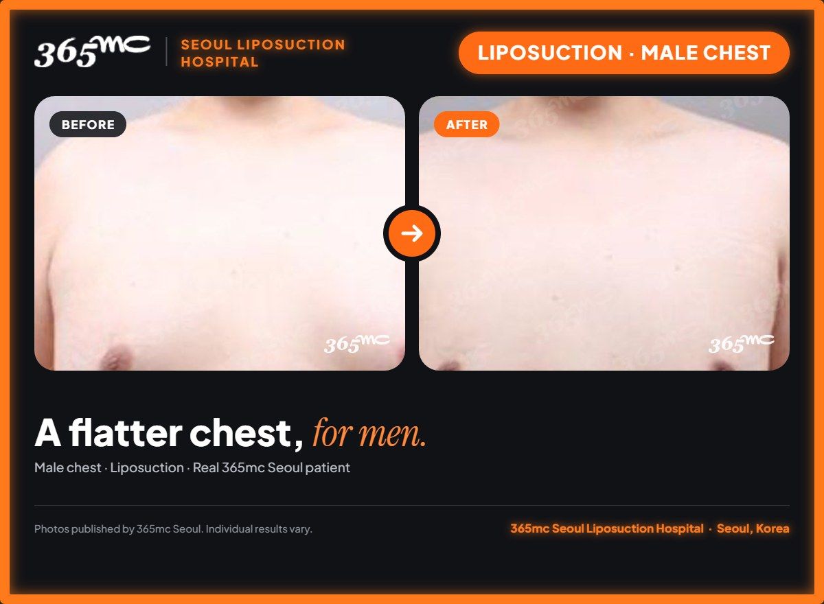 Male chest liposuction before and after at 365mc Seoul Liposuction Hospital - A flatter chest, for men.