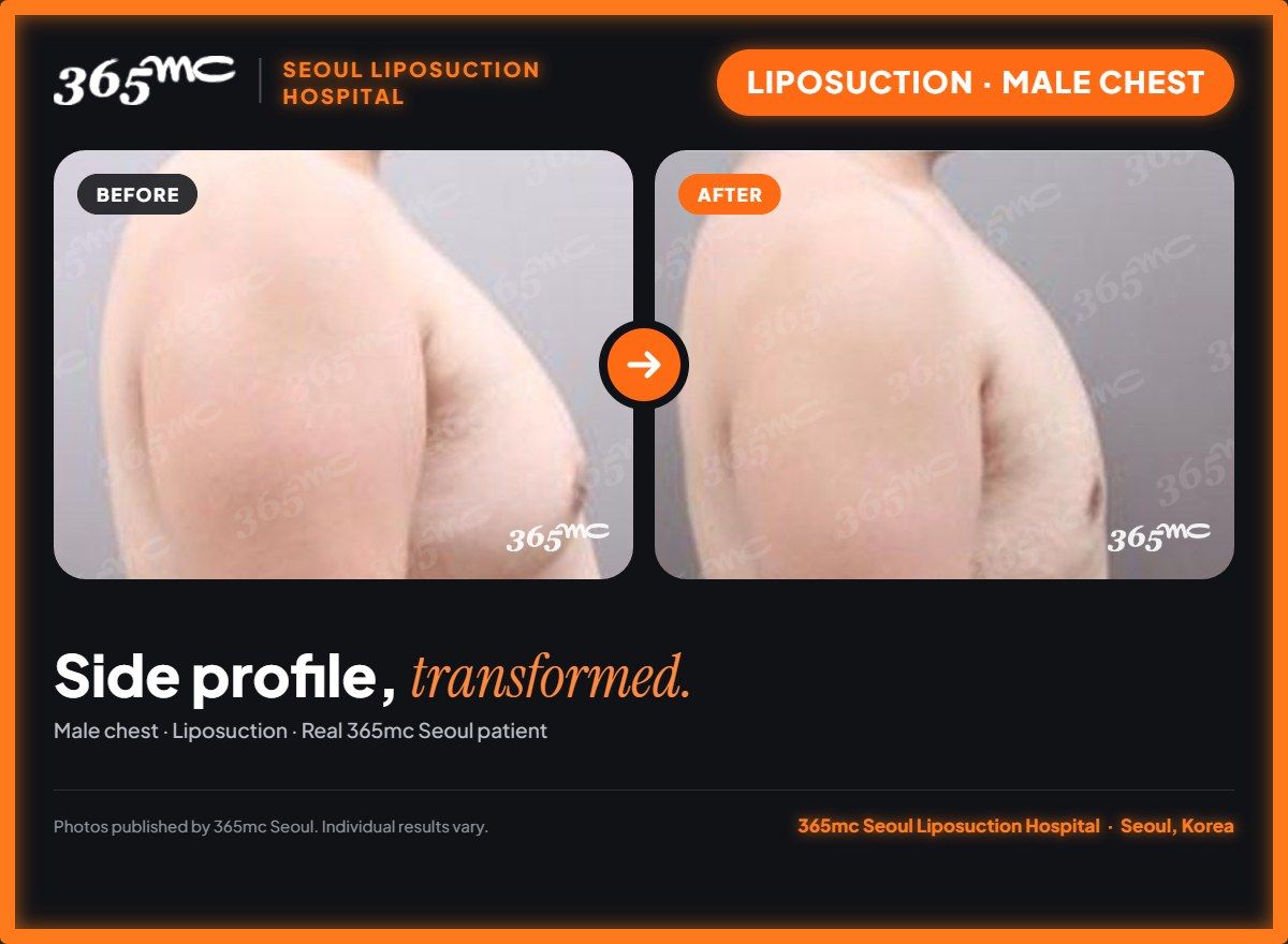 Male chest liposuction before and after at 365mc Seoul Liposuction Hospital - Side profile, transformed.