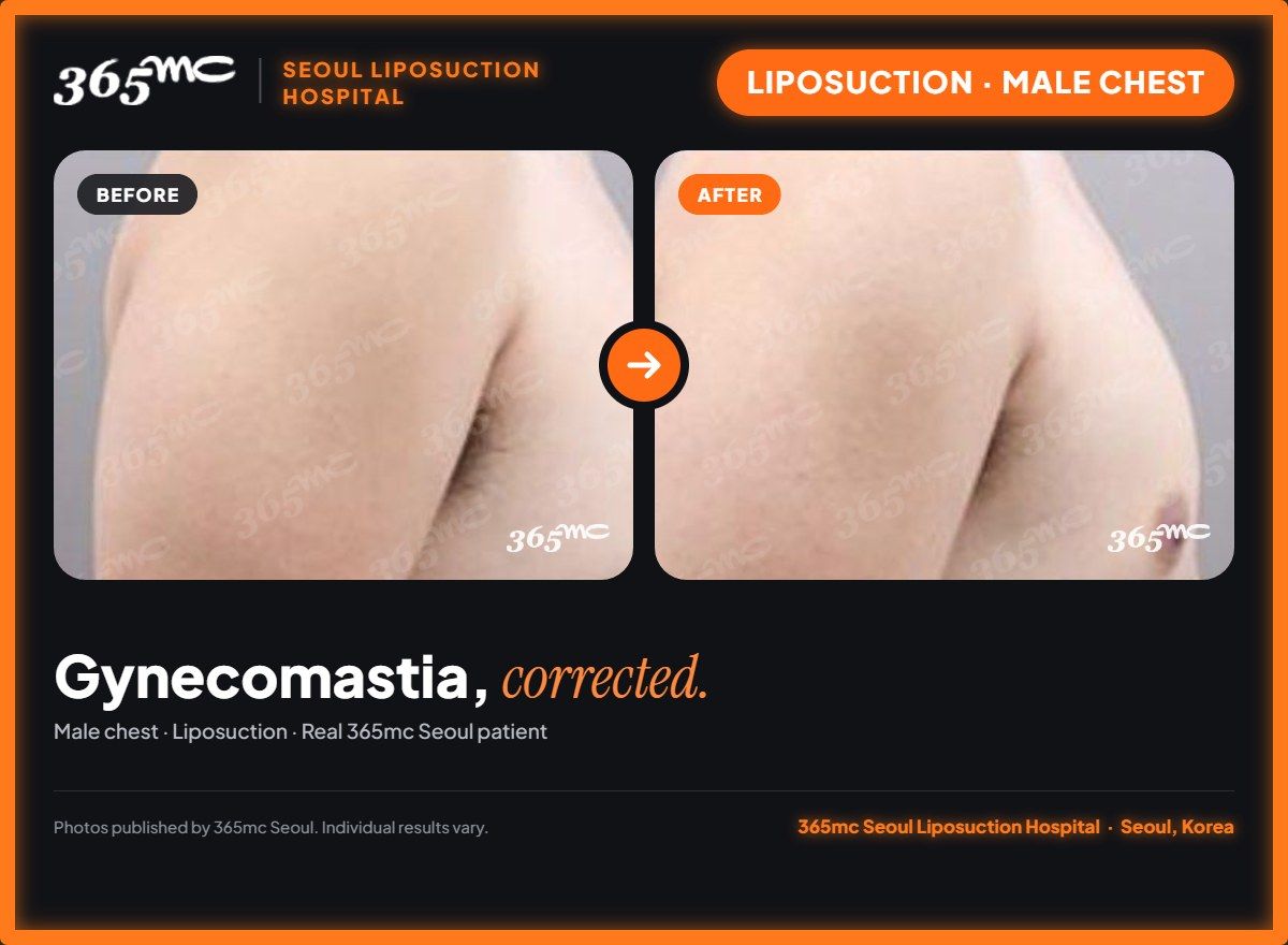 Male chest liposuction before and after at 365mc Seoul Liposuction Hospital - Gynecomastia, corrected.