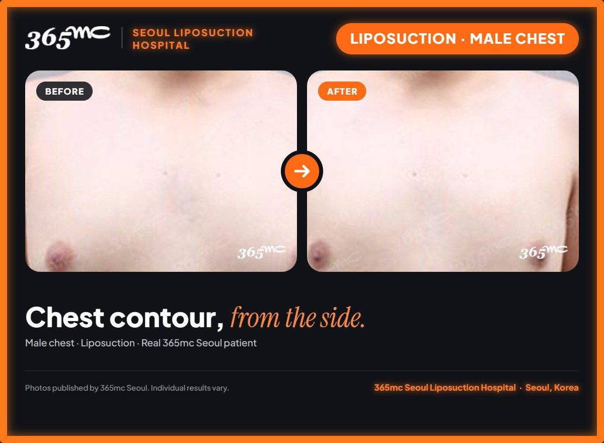 Male chest liposuction before and after at 365mc Seoul Liposuction Hospital - Chest contour, from the side.