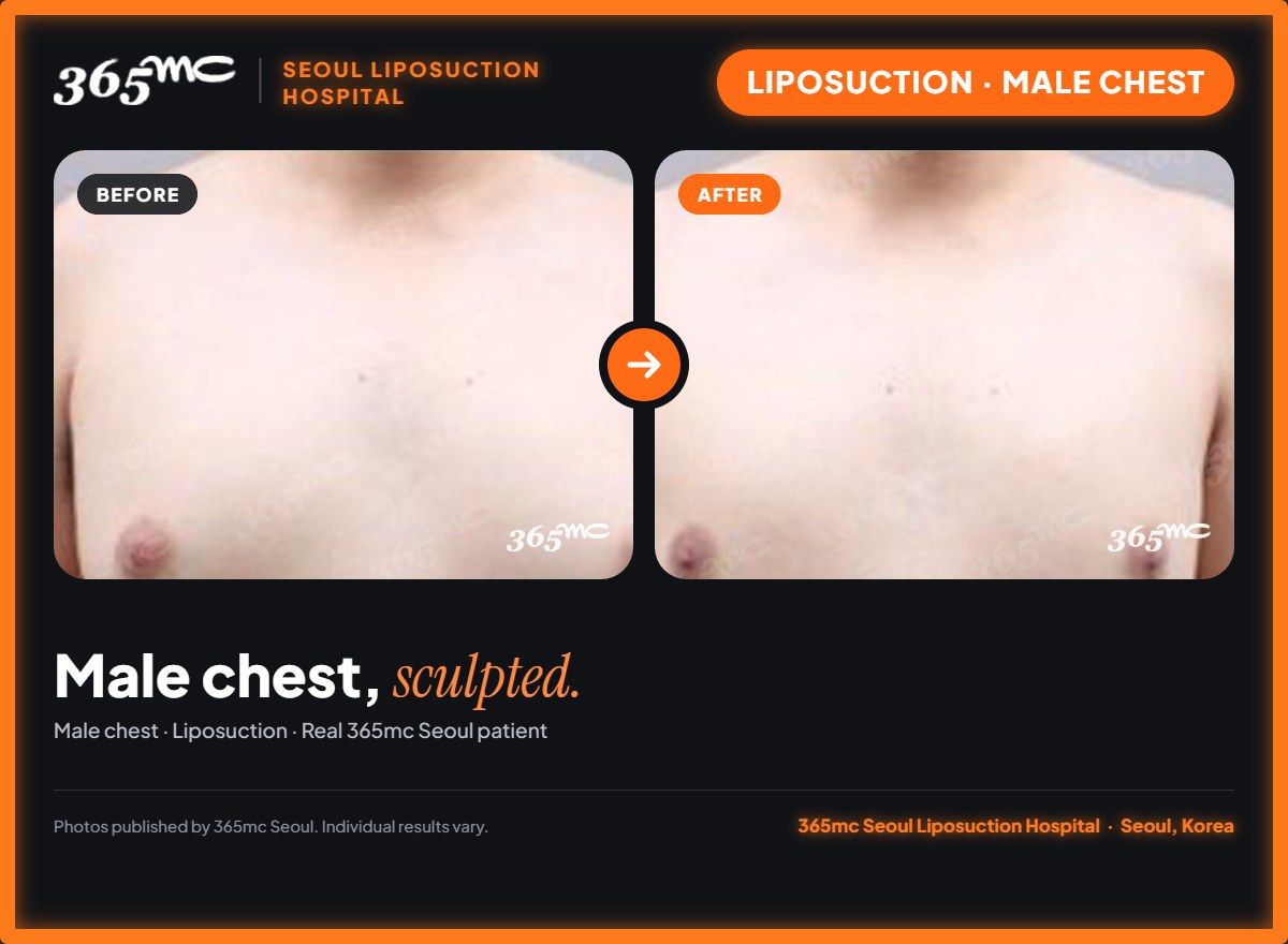 Male chest liposuction before and after at 365mc Seoul Liposuction Hospital - Male chest, sculpted.
