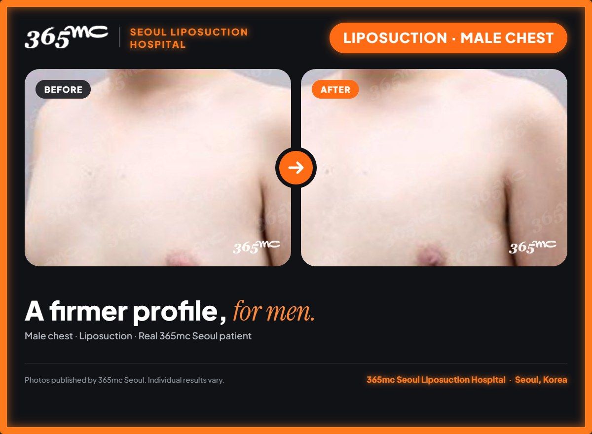 Male chest liposuction before and after at 365mc Seoul Liposuction Hospital - A firmer profile, for men.