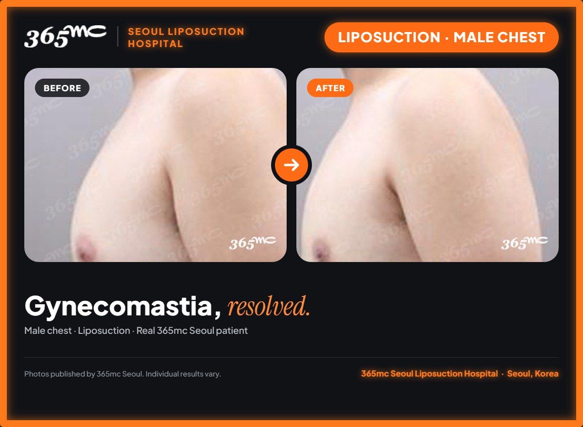 Male chest liposuction before and after at 365mc Seoul Liposuction Hospital - Gynecomastia, resolved.