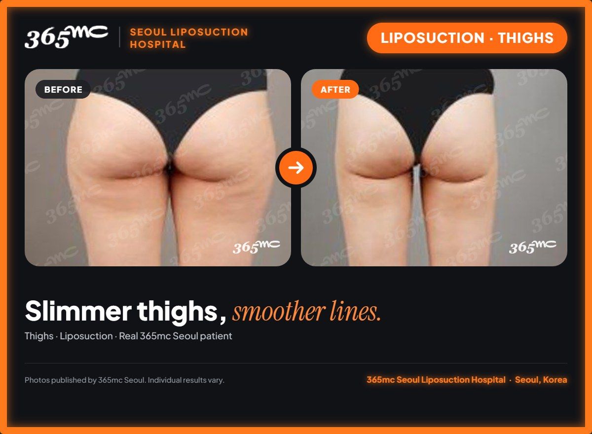 Thighs liposuction before and after at 365mc Seoul Liposuction Hospital - Slimmer thighs, smoother lines.