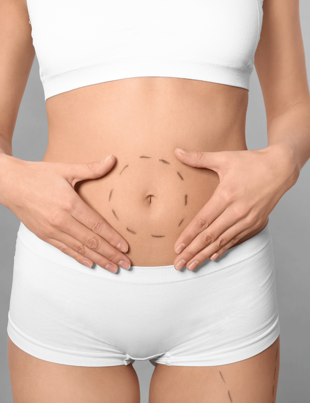 Abdomen LAMS at 365mc Seoul Liposuction Hospital