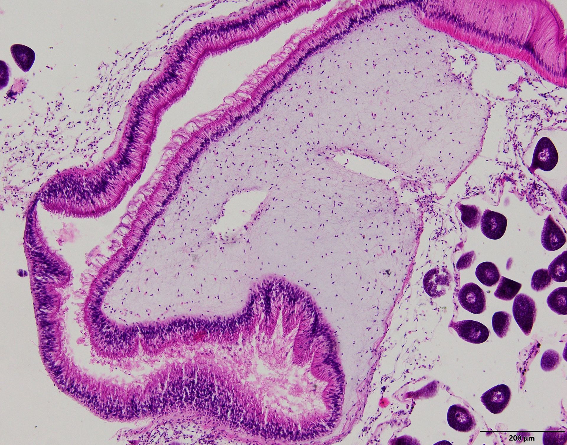 Vista microscópica de una muestra de tejido, que muestra un quiste con estructuras celulares de color rosa y púrpura.