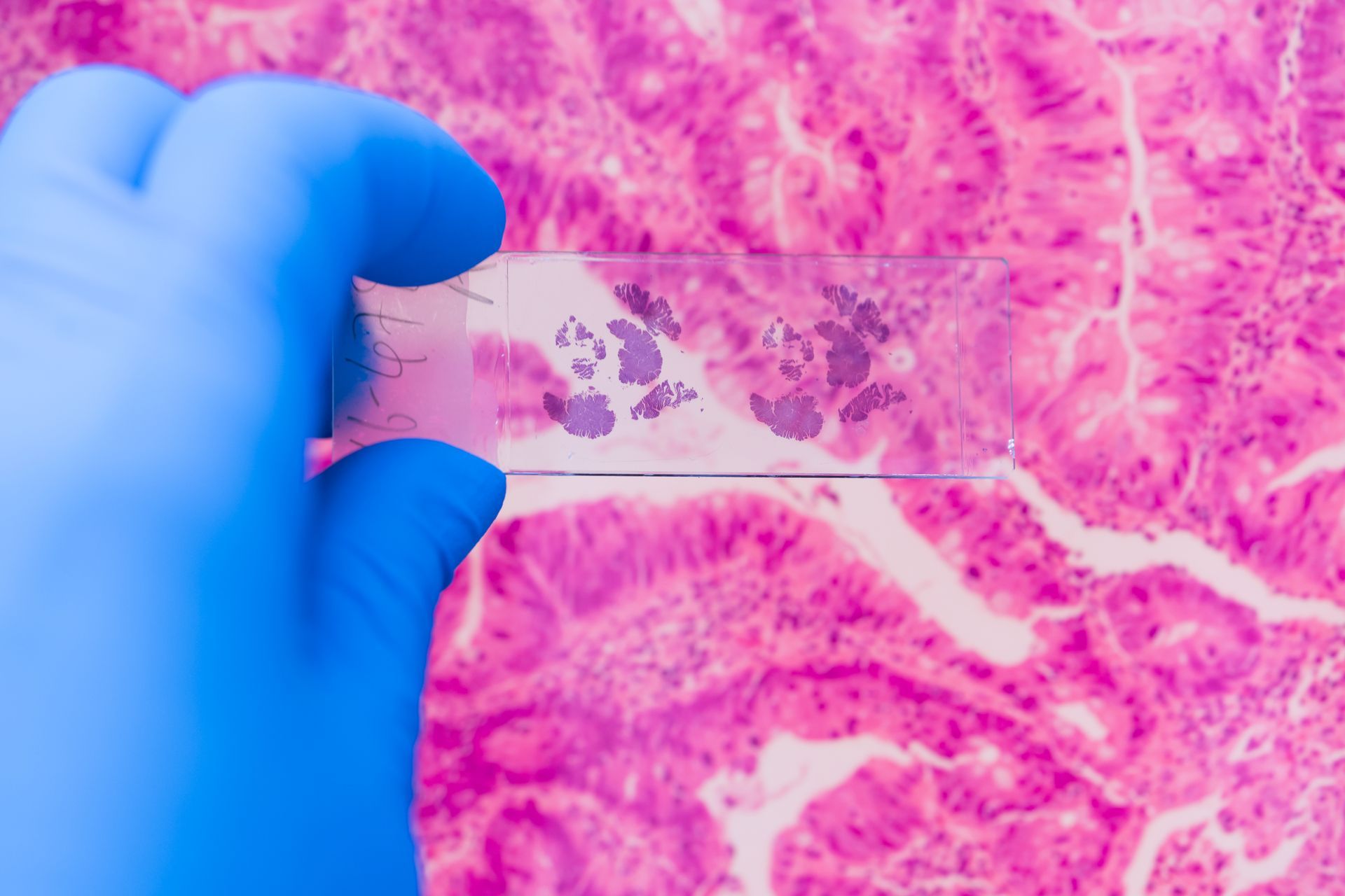 Vista microscópica de una muestra de tejido, que muestra un quiste con tinción rosa y púrpura, rodeado de otras células.