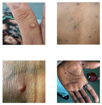 Four close-up photos of skin showing multiple lesions, possibly related to a viral infection.