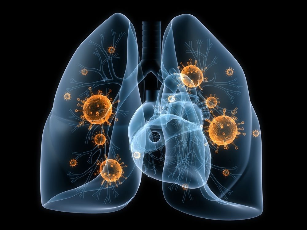 X-ray of lungs and heart with orange virus illustrations.