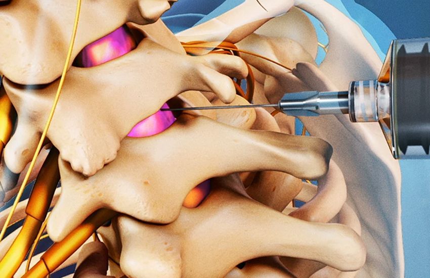 bone injection