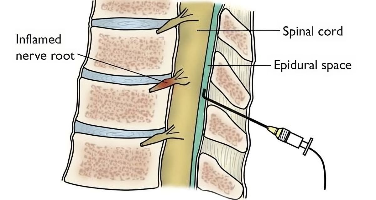 bone injection
