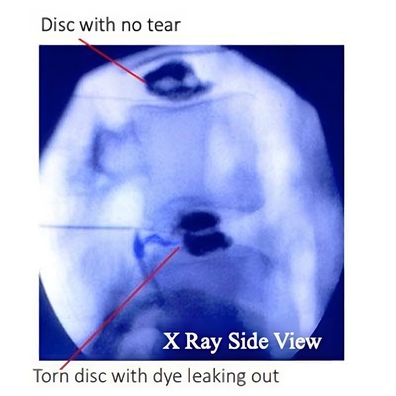 x-ray torn disc