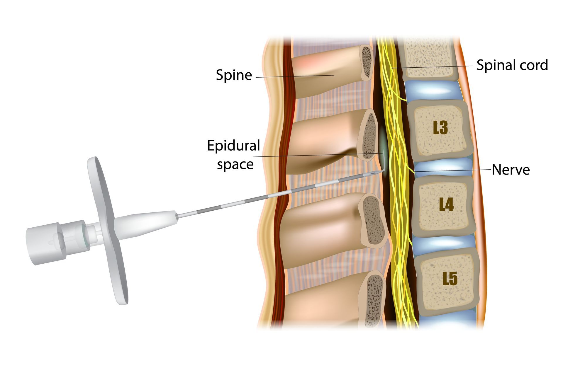 bone injection