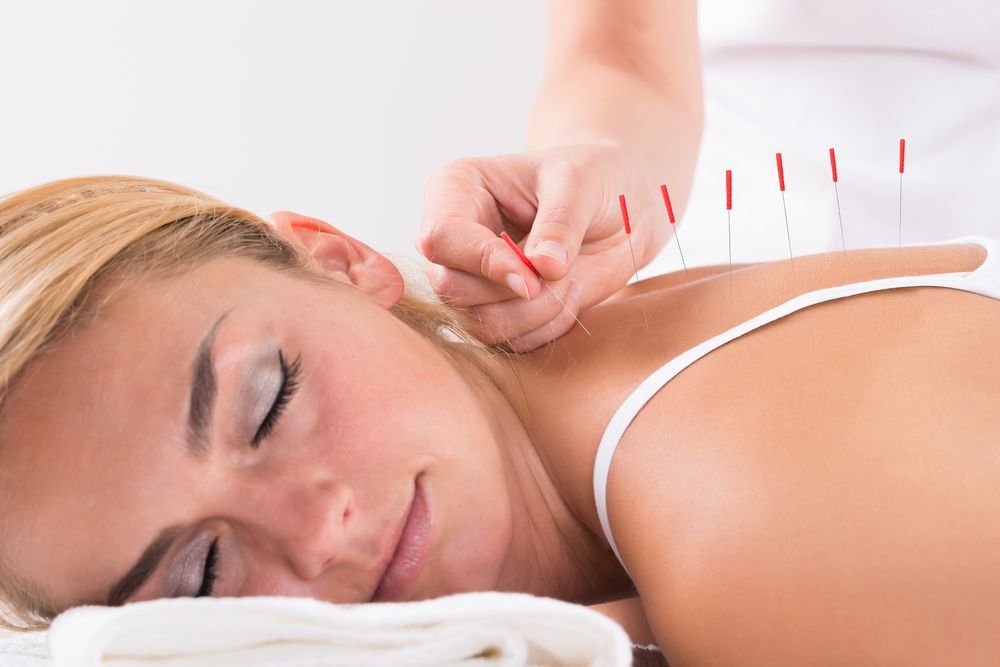 Woman receiving acupuncture on her shoulder; needles inserted.