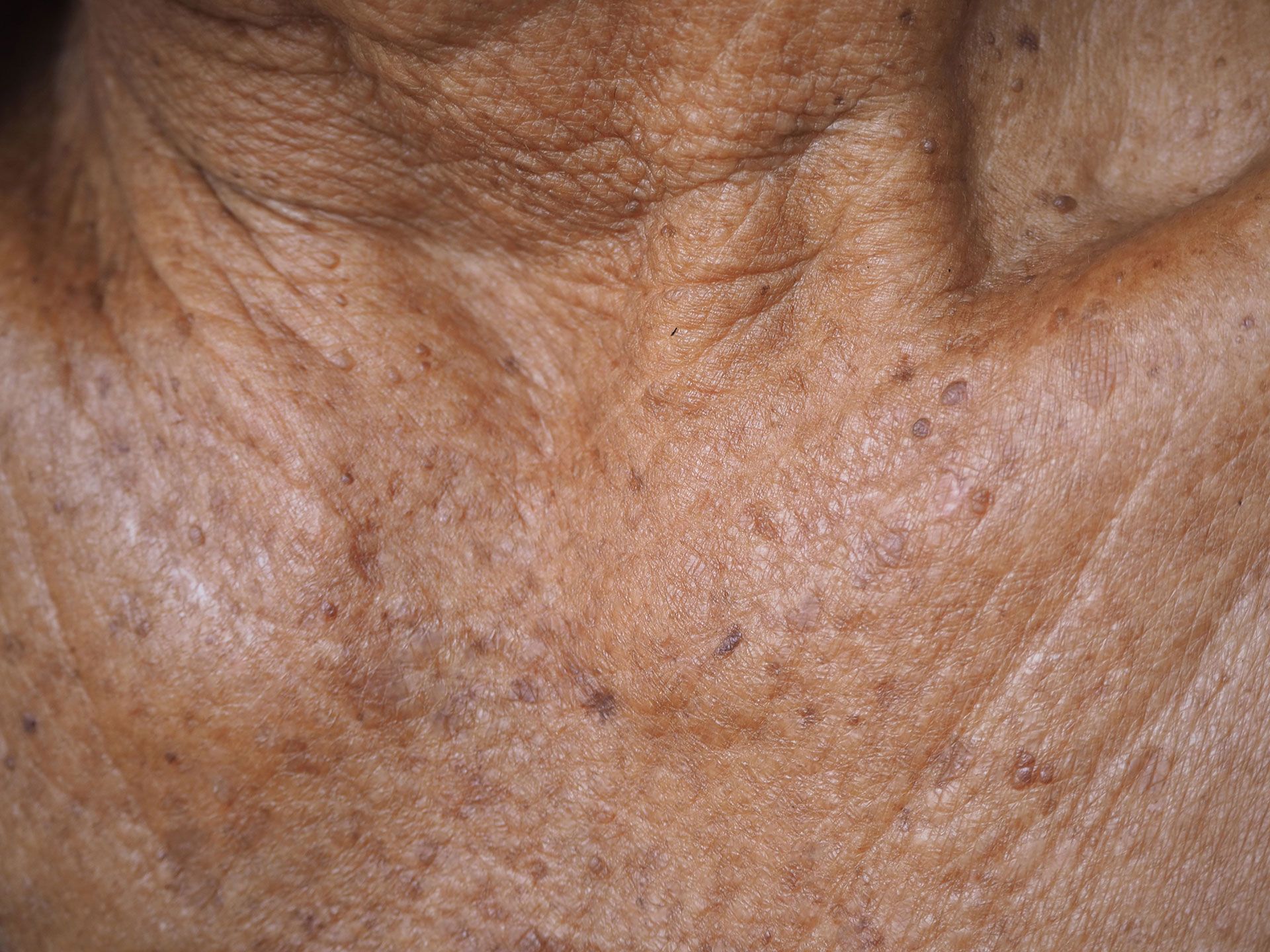 September Spotlight: Understanding Actinic Keratosis and How the Ultra Laser Can Help