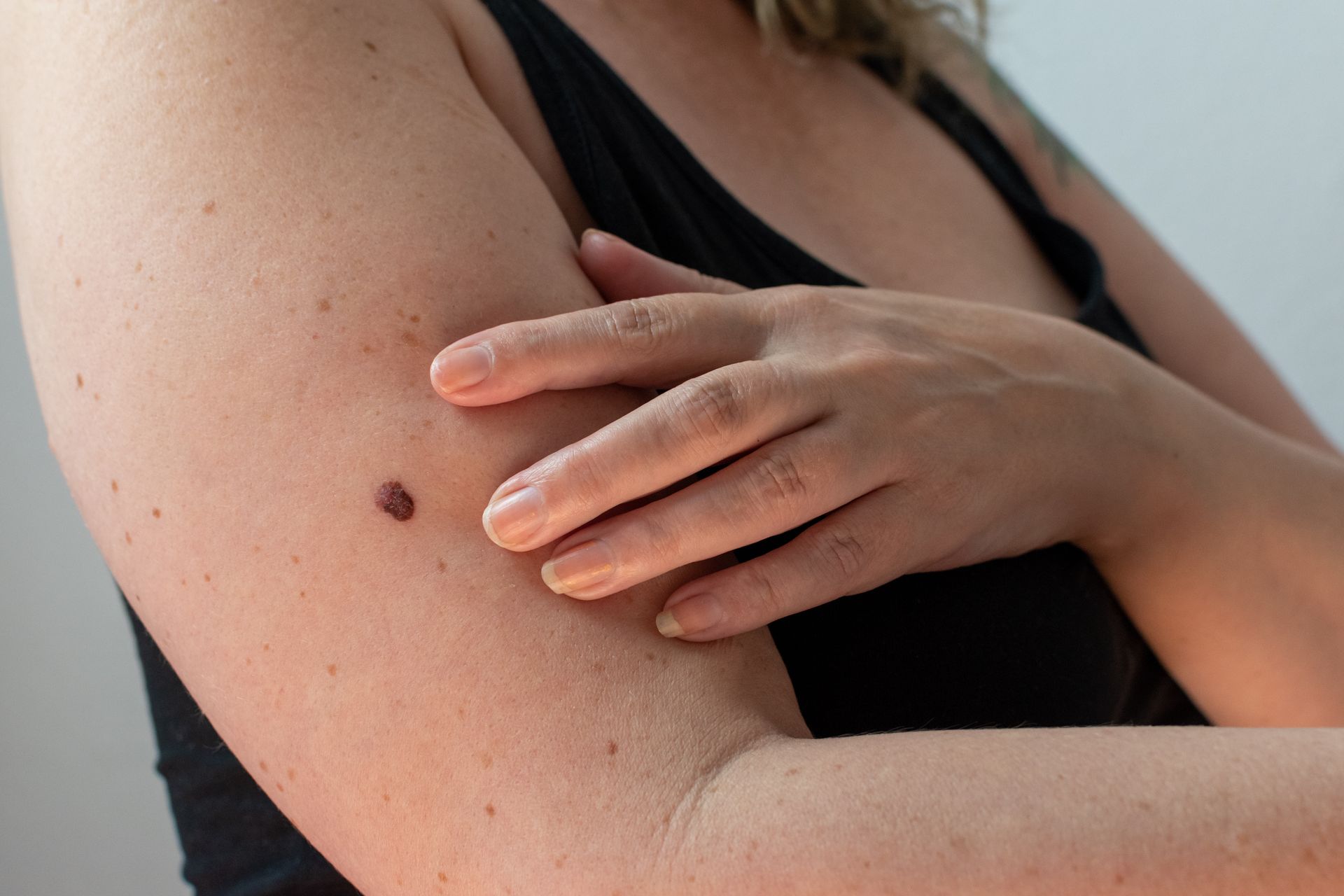 Person applying sunscreen to upper arm with a visible mole