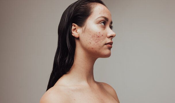 June is Acne Awareness Month: Understanding Acne and Your Treatment Options