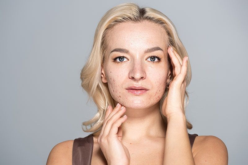 Acne, Scarring