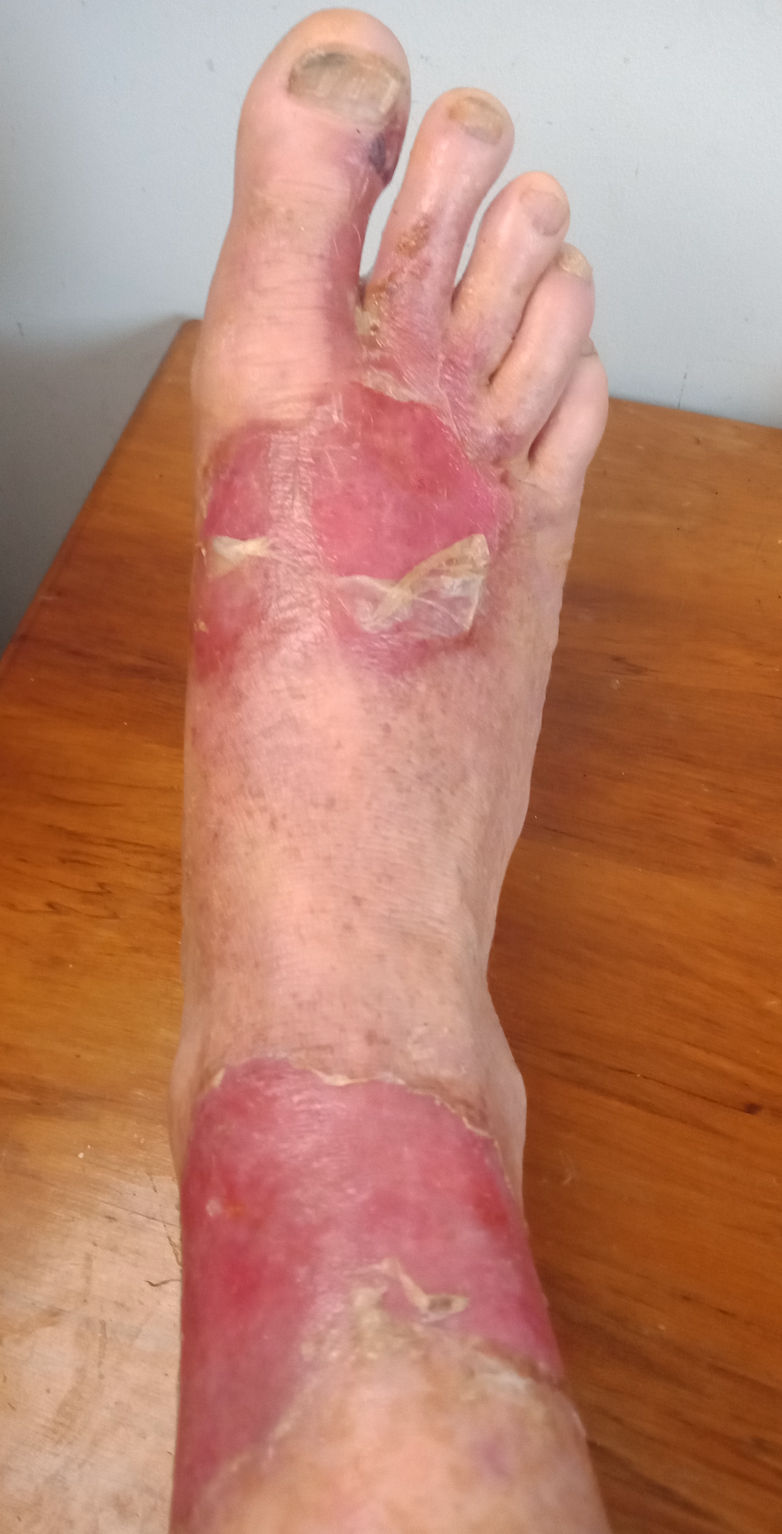 Foot with large, red, open wounds on the ankle and top of the foot. Skin appears damaged and discolored.